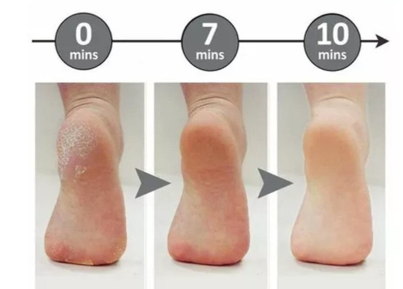 Pulidor de pies anticallos